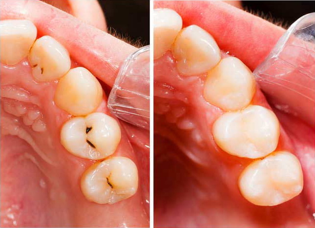 Sanacija zuba - estetske bele plobme